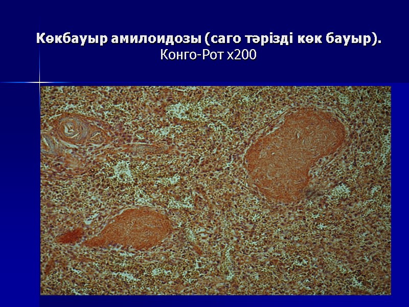 Көкбауыр амилоидозы (саго тәрізді көк бауыр).   Конго-Рот х200